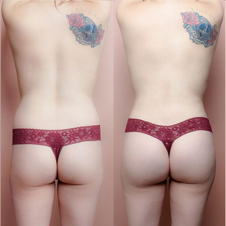 360 Lipo and BBL Before and After image back view